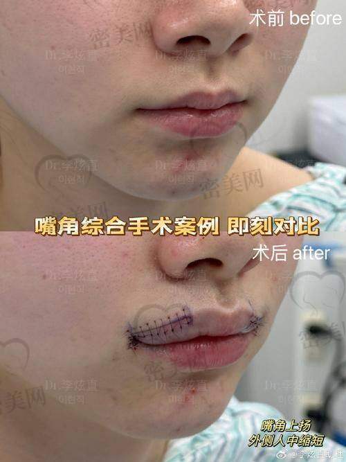 其他医院同期对比:渼淳玉颜人中缩短技术更成熟