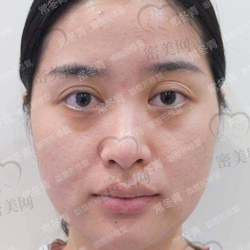 青岛博士整形双眼皮价格怎么计算?不同项目价格区间全分析