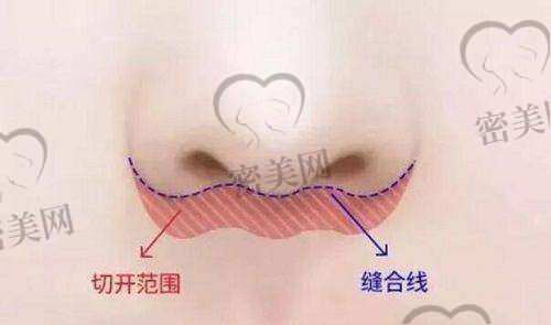 深圳福雅医疗人中缩短术后护理要知道这些