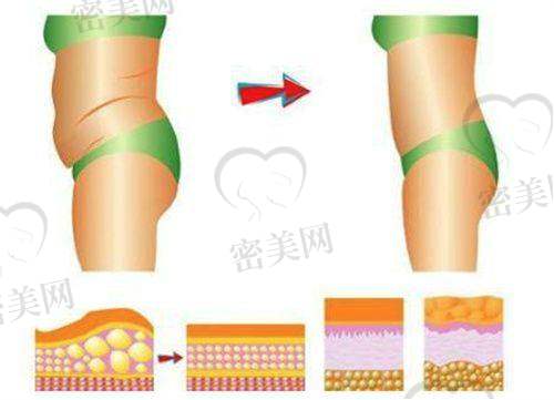 土麦森吸脂vs传统吸脂:技术优势对比一览表