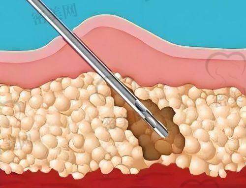 深圳曹孟君土麦森吸脂术后成效怎么样?