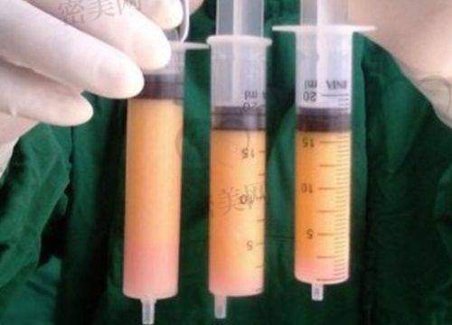 曹孟君医生还有那些“硬核技术”适合塑形需求的人群?