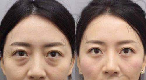 湘潭中 心医院注射幼态脸价格优势在哪?与湘潭同类私立机构对比