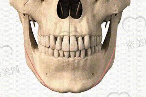 医美项目与“馒化脸”的关系