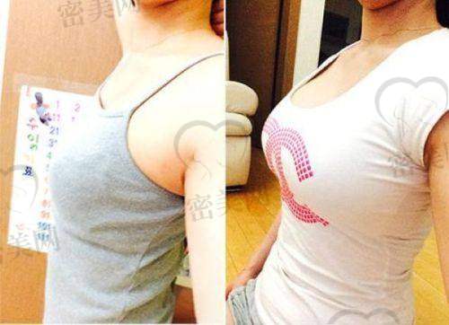 傲诺拉乳房假体的未来发展趋势