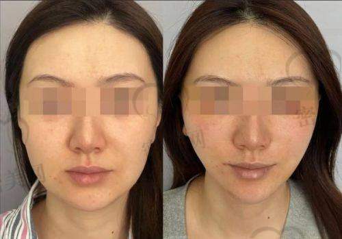 怎么才能预约到谭永嘉医生做微拉美5.0面部提升?