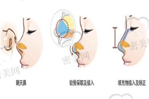 四、其他类型馒化脸的修复方法