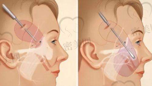 馒化脸是否会自然消失