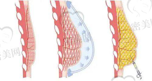 安可忍医生磨骨技术靠谱,有个性化设计