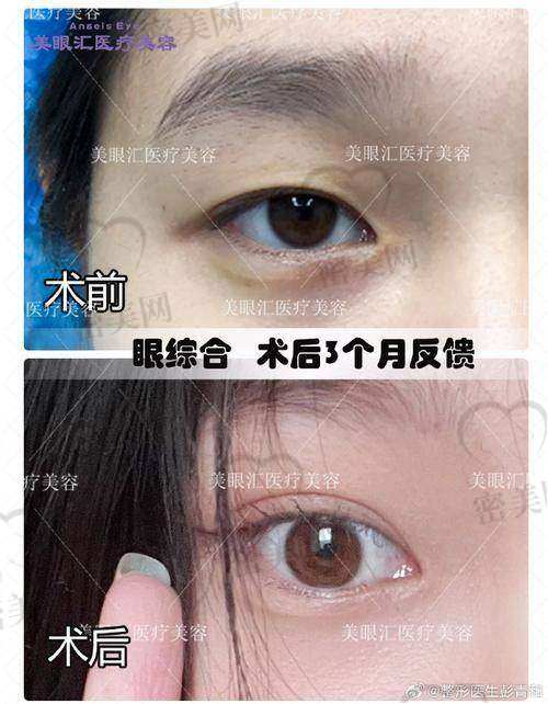 田国静双眼皮成效惊艳
