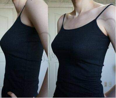 傲诺拉假体的成本分析