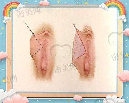 王晓娟修复术:8300 元背后的神奇优势