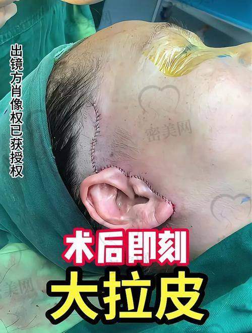 沈阳名流整形做小切口拉皮——靠谱、安心、性价比高!