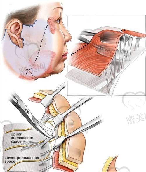 王松院长小切口拉皮技术怎么样?做出来能保持多久?