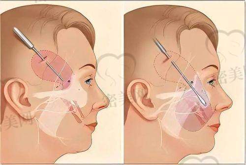 第五代高位SMAS拉皮术到底神在哪?详细解析术式核心亮点