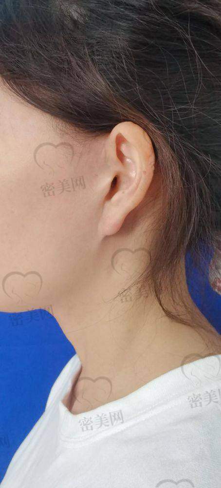 眼周筋膜提升维持多久?比玻尿酸或线提升划算吗?