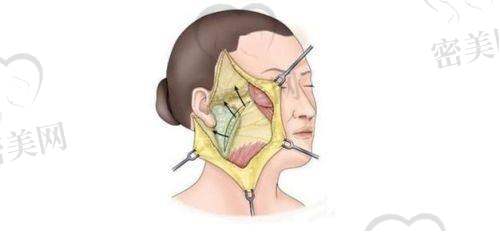 蒲兴旺医生做的小拉皮术后修复怎么样?维持时间长吗?