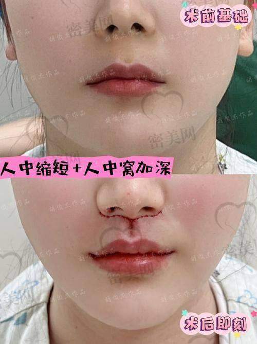 深圳福雅医疗人中缩短——胡俊杰医生技术牛在哪?