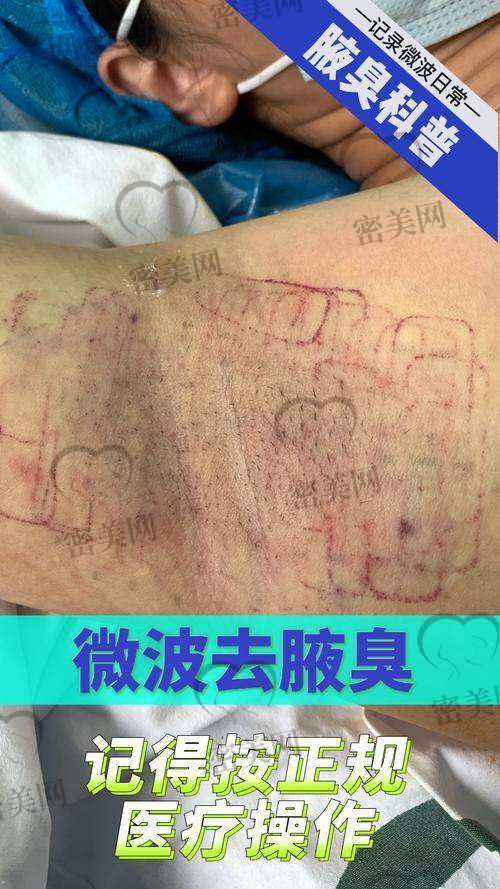 石家庄美联臣整形医院高玉伟除腋臭:口碑爆棚的秘密