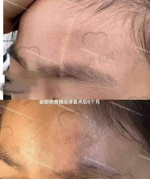 做一次疤痕治疗到底要多少钱?用户实例真实反馈