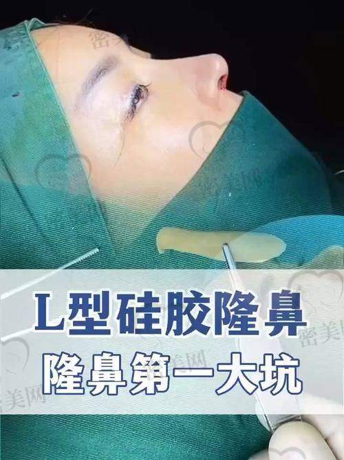 强烈推荐文丰医生做鼻子