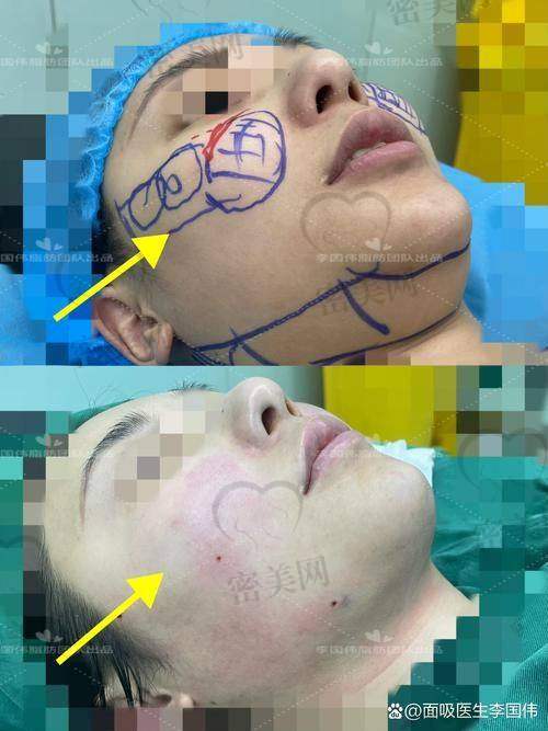 深圳曹孟君土麦森吸脂的用户体验好在哪?