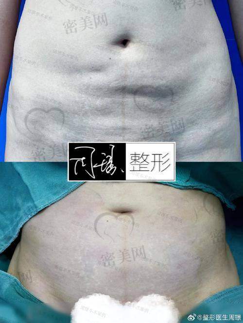 深圳曹孟君整形土麦森吸脂技术究竟有多神?