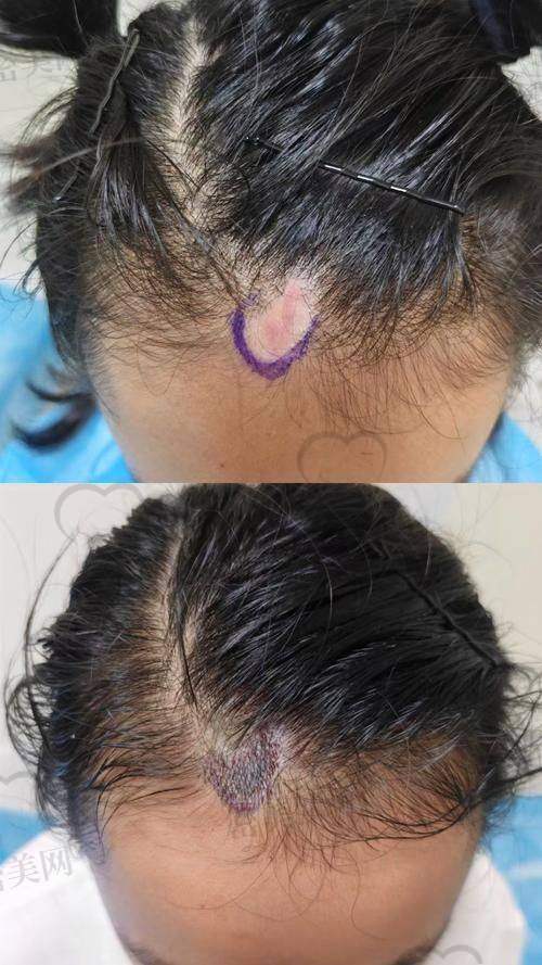 绍兴柯桥金柯桥医院植发科技术方面靠谱吗?