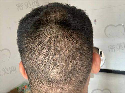 绍兴柯桥金柯桥医院植发科资质如何?正规医院背景靠谱