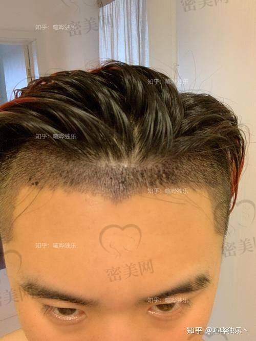 绍兴柯桥金柯桥医院植发科收费标准贵吗?价格透明吗?