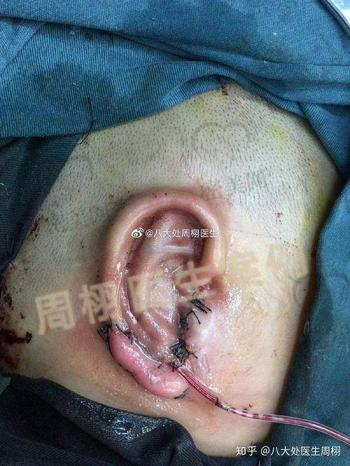 口碑爆棚:顾客眼中的美联臣郭东超耳部整形