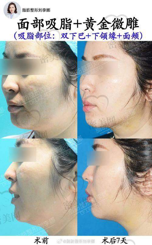 深圳宝丽医疗美容:郑梦雄医生