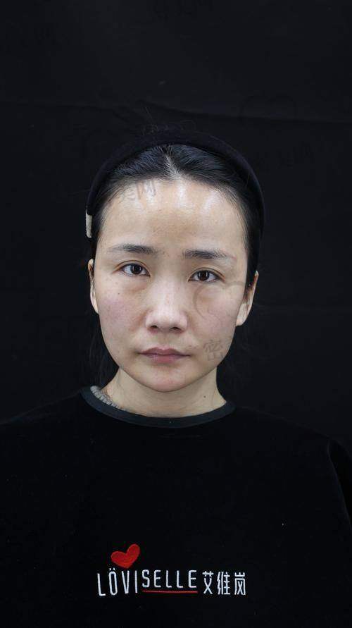 石家庄美联臣整形医院:下颏整形的理想之选!