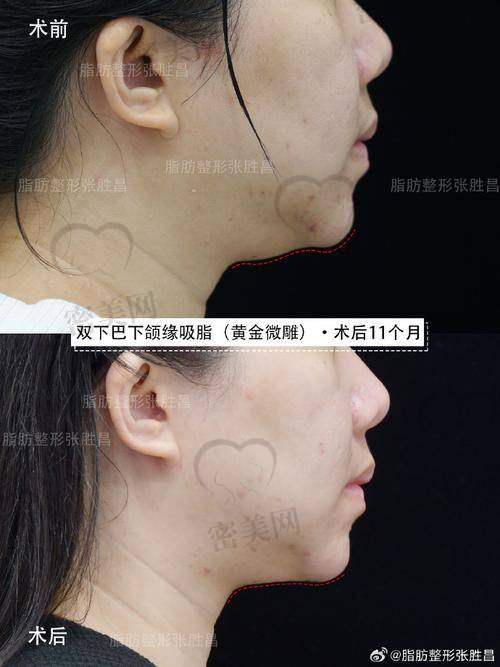 石家庄美联臣整形医院郭东超下颏整形:真人实例见证奇迹!