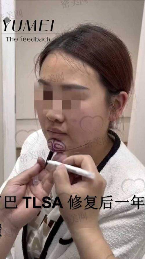 石家庄美联臣整形医院郭东超:16800 元起的下颏整形,性价比之王!