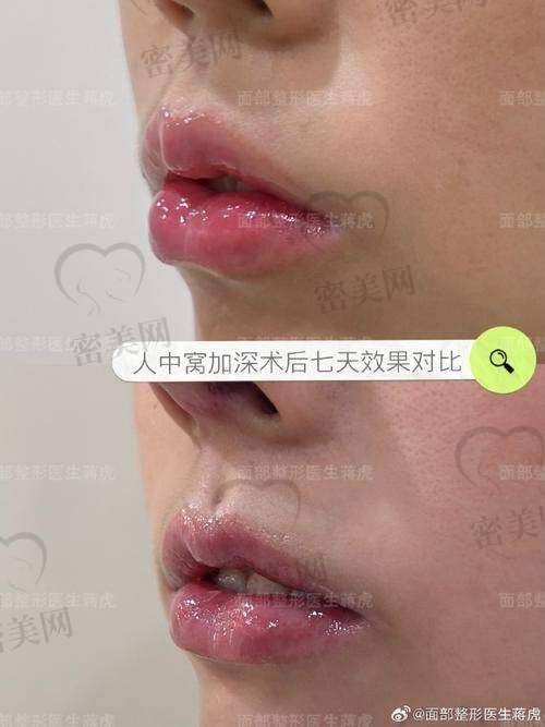 为什么说深圳福雅的人中缩短术更自然?