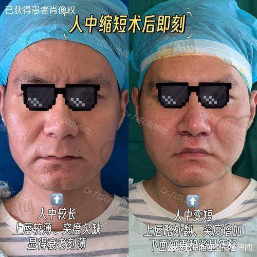 深圳福雅胡俊杰人中缩短价格表(参考)