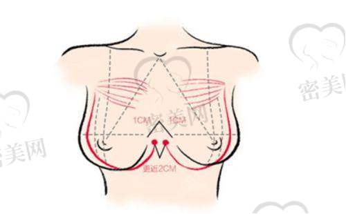 傲诺拉隆胸假体价格大揭秘