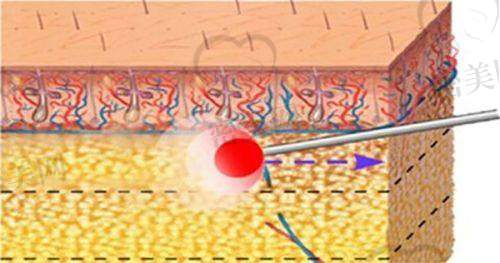 哈尔滨艺星整形全身吸脂多少钱?价格明细来了!