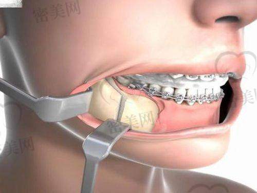 仍然可以现场挂号,适合年长患者或临时决定手术者