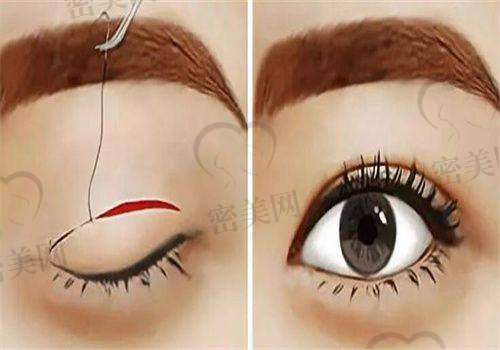 口碑评价:王晓娟埋线双眼皮的极高人气