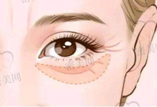 唐山煤醫(yī)尚美整形醫(yī)院郭萬厚祛眼袋:價(jià)格香到離譜