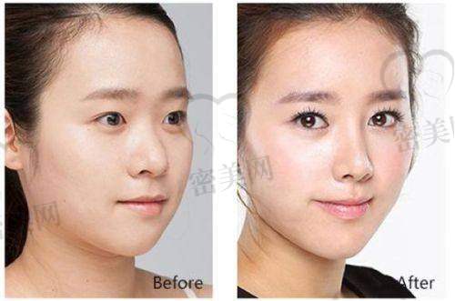 术后修复:每一天都是惊喜的等待