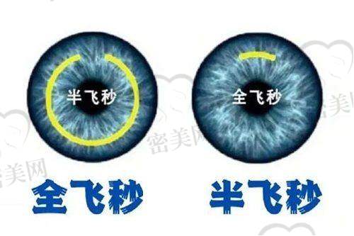 近视眼矫正技术丰富,选择多样