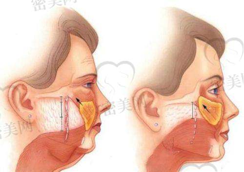 上海九院点阵激光种类与费用明细