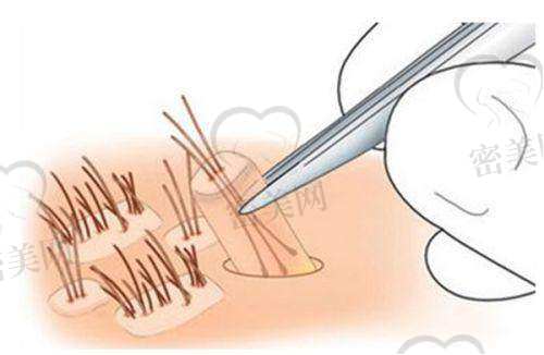 福州新生植发医院:全流程微创体系,女性植发实力派