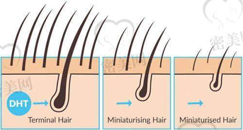 福州熙朵植发机构:六大技术结合,精细化雕刻细琢每一根发丝