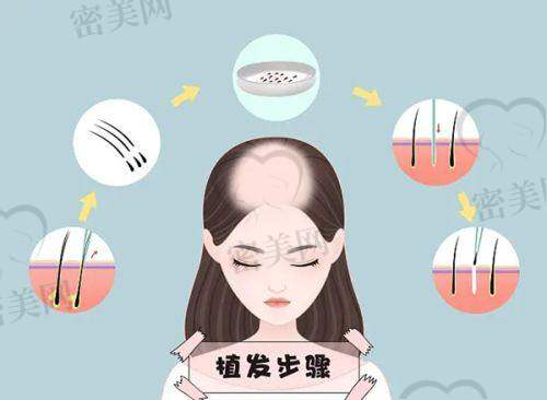 医生种头发靠不靠谱?术后的修复情况如何?