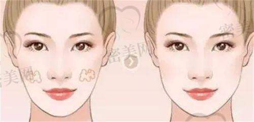 上海九院激光祛痘、祛痘印项目方案与报价