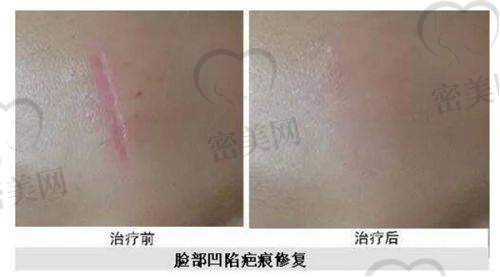 瑞诗娇医疗美容:水光针小气泡,补水王者!